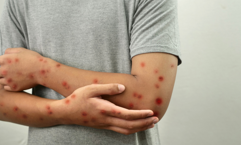Saúde nega caso confirmado de Mpox em Niterói após boato sobre a doença na cidade